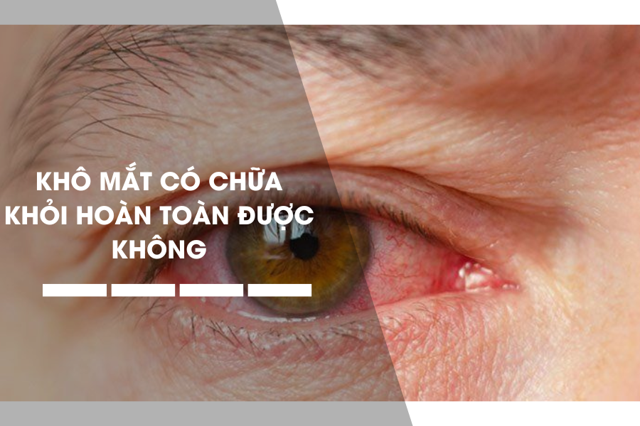 Bệnh Khô Mắt Có Chữa Khỏi Hoàn Toàn Được Không